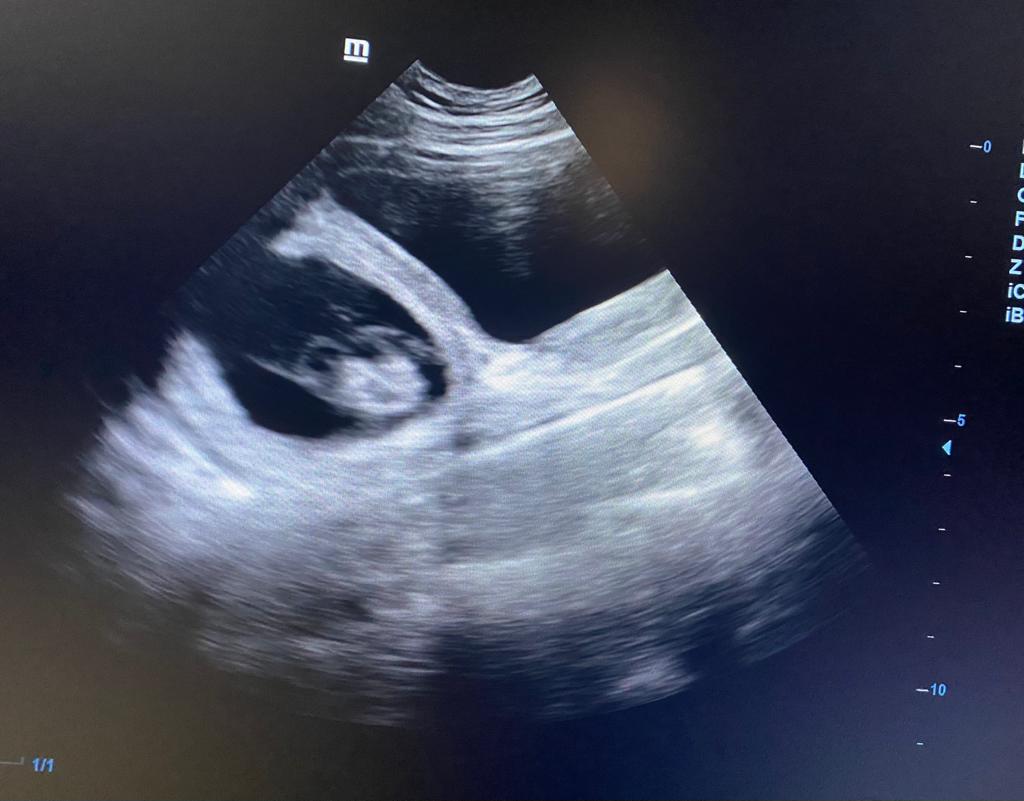 Ein Ultraschallbild vom Bauch der Pyri-Mutter. Ein Fötus mit angezogenen Beinchen ist erkennbar
